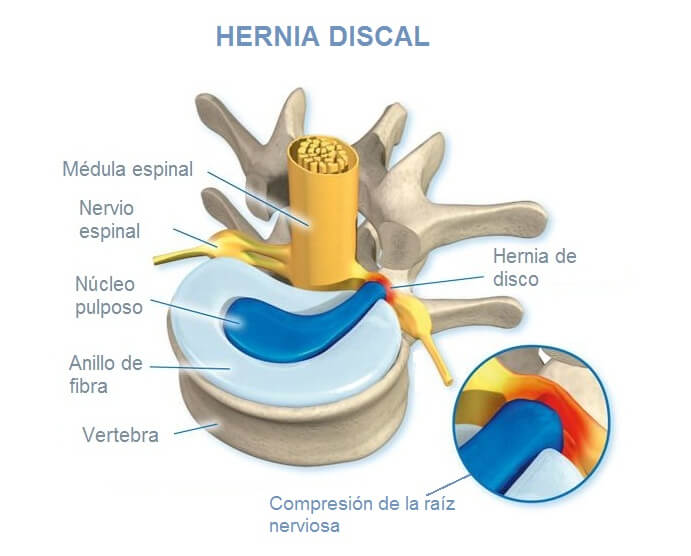 Hernia discal cervical